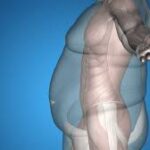 Obésité : un nouveau parcours d’accompagnement au CHU de Guyane 