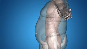 Obésité : un nouveau parcours d’accompagnement au CHU de Guyane